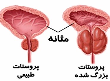 بزرگي پروستات